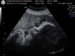 Mirela com 36 semanas e 6 dias: tão grande que quase não conseguimos pegar o perfil dela...A carinha enfiada na placenta...